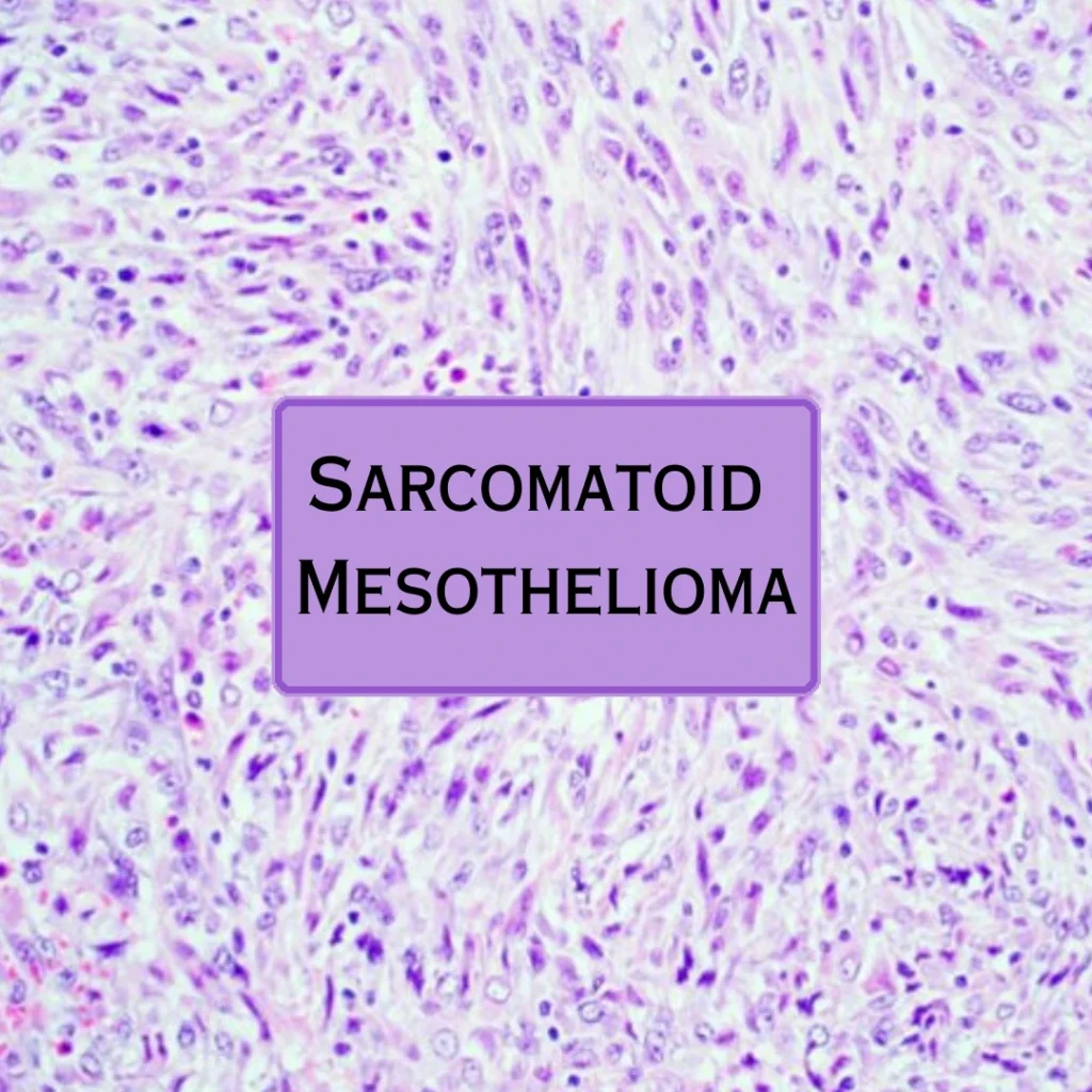 Sarcomatoid Mesothelioma
