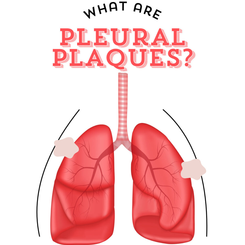 What are pleural plaques?