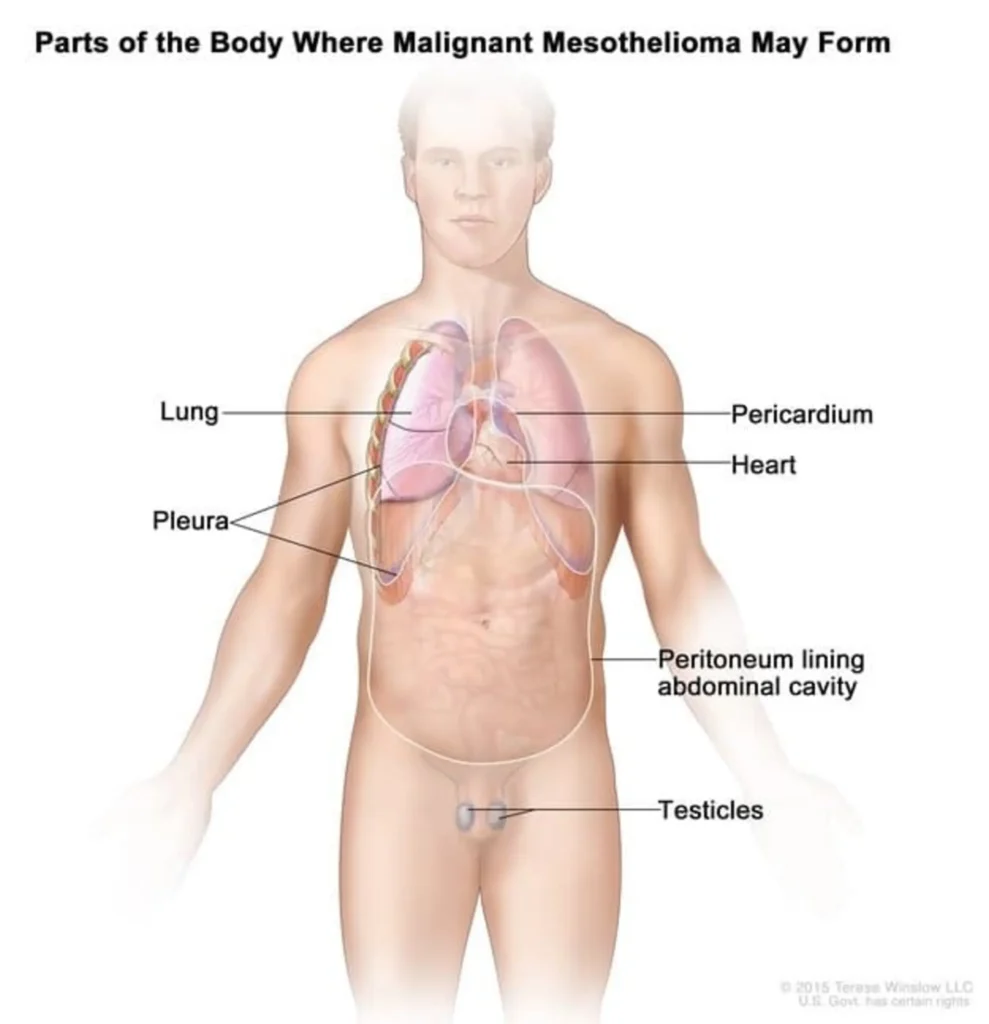 Parts of the body where mesothelioma may form: 
Lung (pleura)
Pericardium (Heart) 
Peritoneum
Testicles