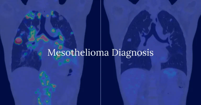 Mesothelioma Diagnosis