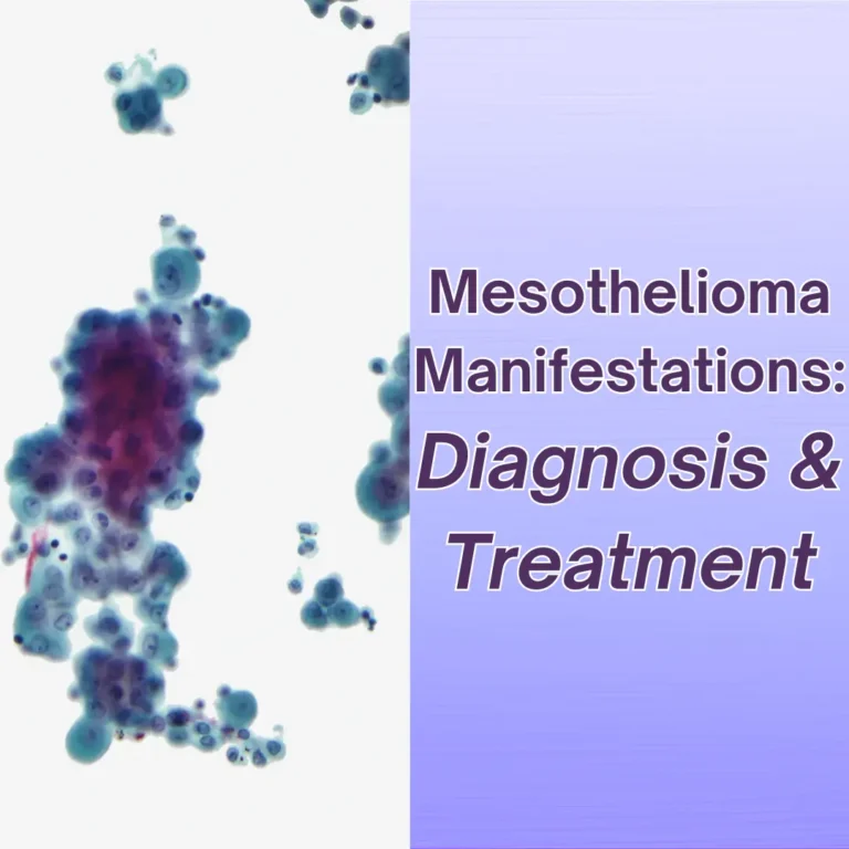 Diagnosis and Treatment of Mesothelioma